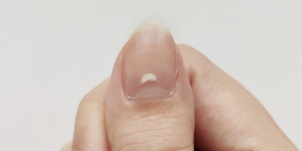 5 razones por las que hay manchas blancas en las uñas y cómo evitarlas