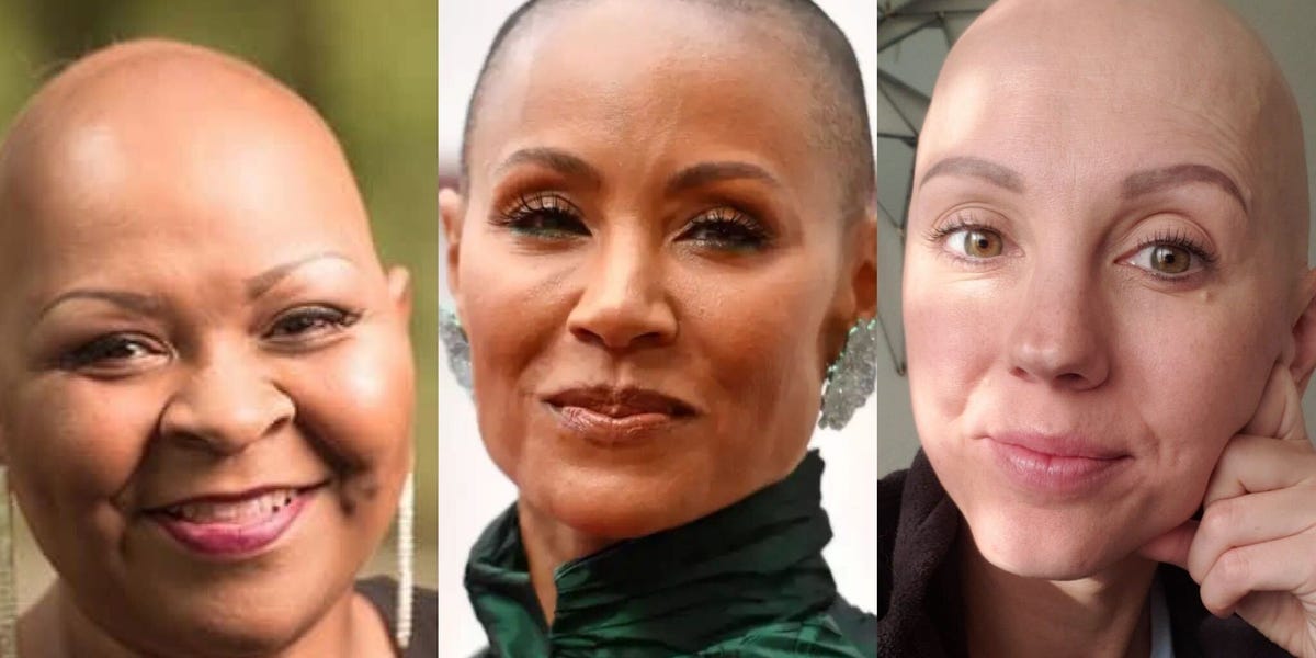 Desde el acoso escolar hasta los traumáticos tratamientos fallidos: las mujeres con alopecia comparten los dolorosos recuerdos que desencadenó la broma de Chris Rock, y por qué entienden la reacción d
