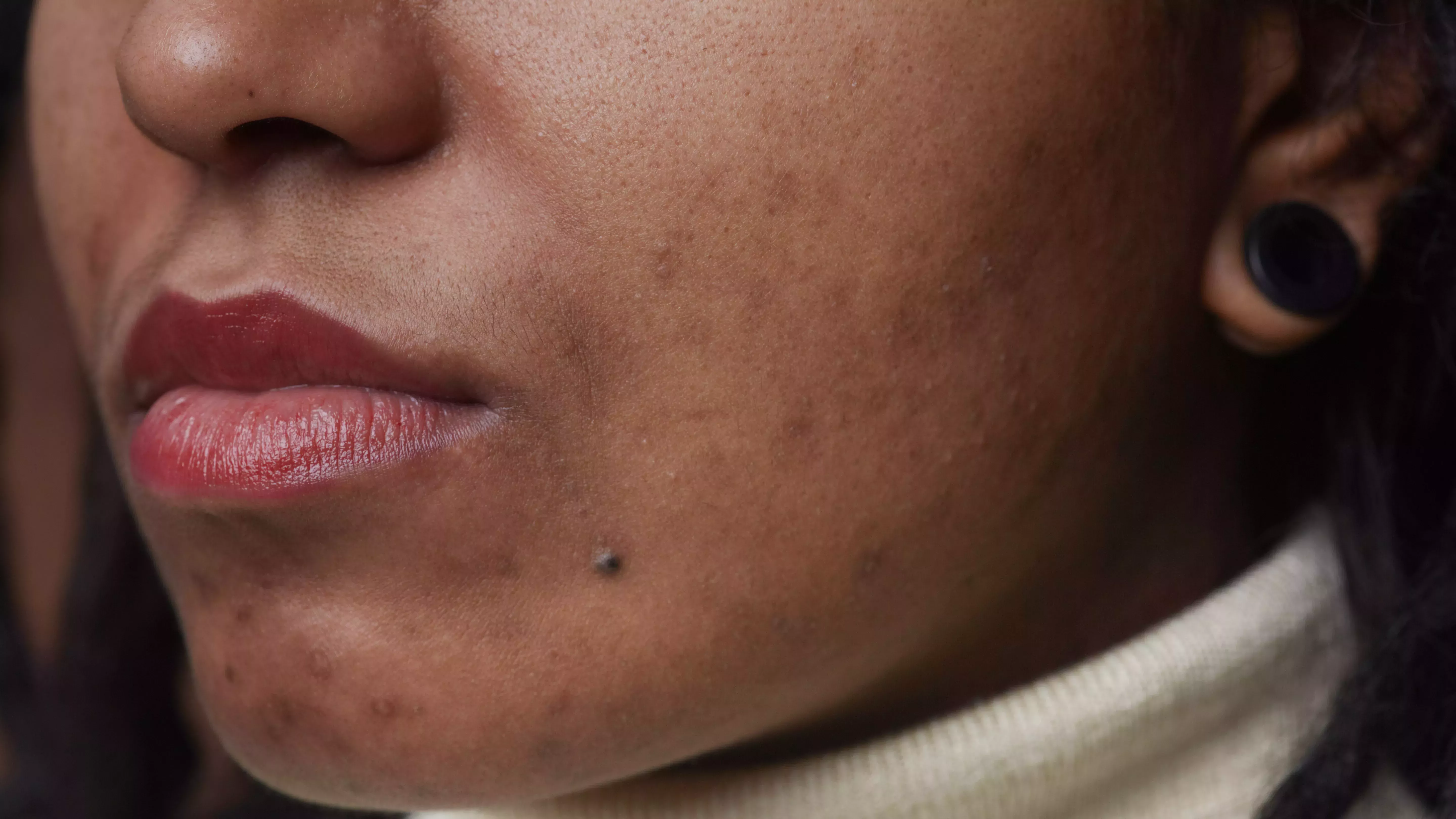 Guía de una chica morena para tratar el acné