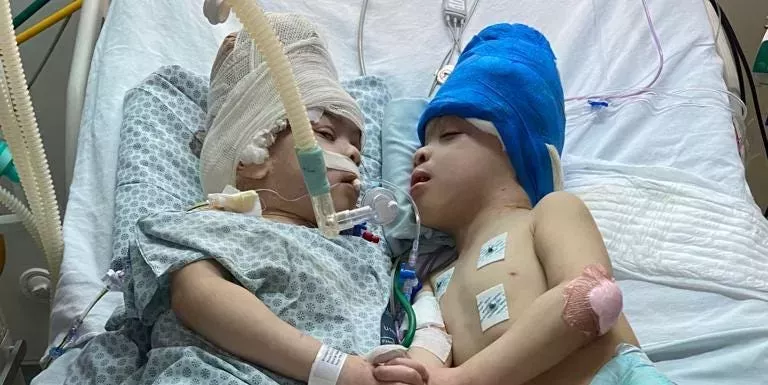 Los gemelos unidos cuyos cerebros estaban fusionados han sido separados en una operación de 27 horas