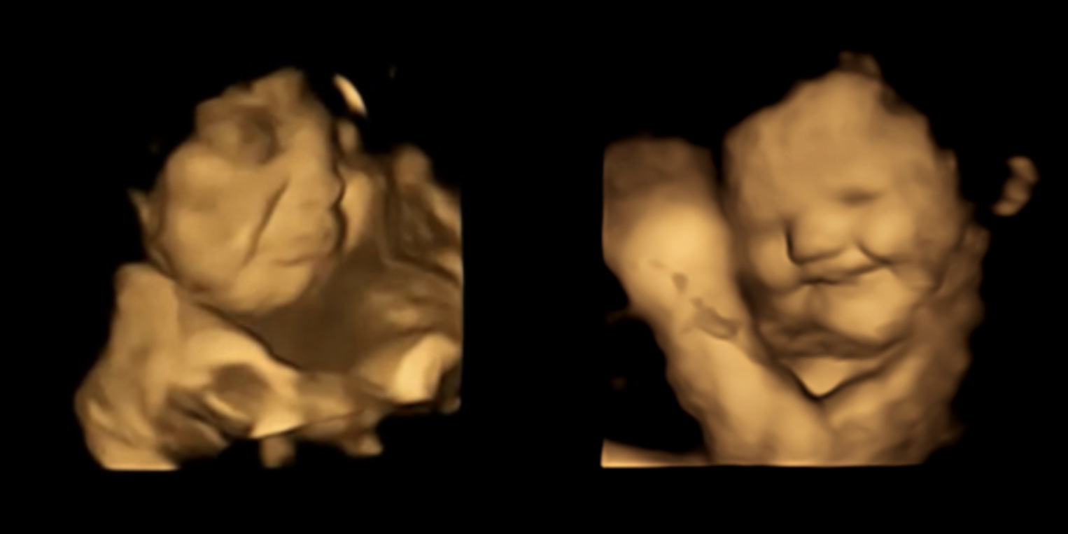 El sabor de la col rizada hace que los bebés no nacidos hagan una mueca, pero sonríen con las zanahorias, según un nuevo estudio de imagen