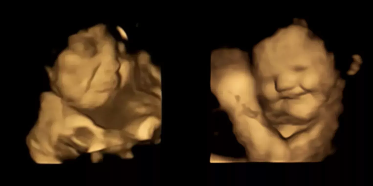 El sabor de la col rizada hace que los bebés no nacidos hagan una mueca, pero sonríen con las zanahorias, según un nuevo estudio de imagen