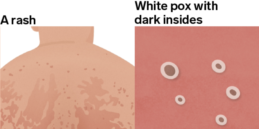 Las imágenes muestran el aspecto real de las lesiones y erupciones de la viruela del mono en diferentes tonos de piel y partes del cuerpo, y cómo cambian con el tiempo