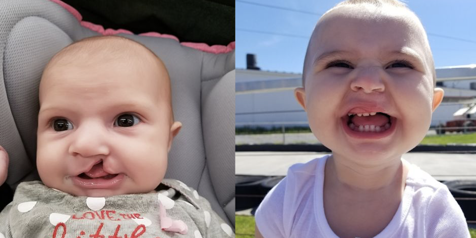 Un pediatra aseguró que mi nieta moriría por tener labio leporino