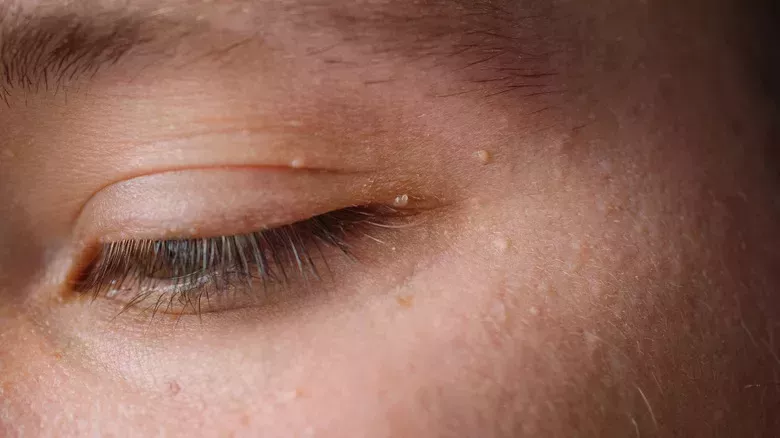 Cuál es la diferencia entre los milios y los puntos blancos - La lista