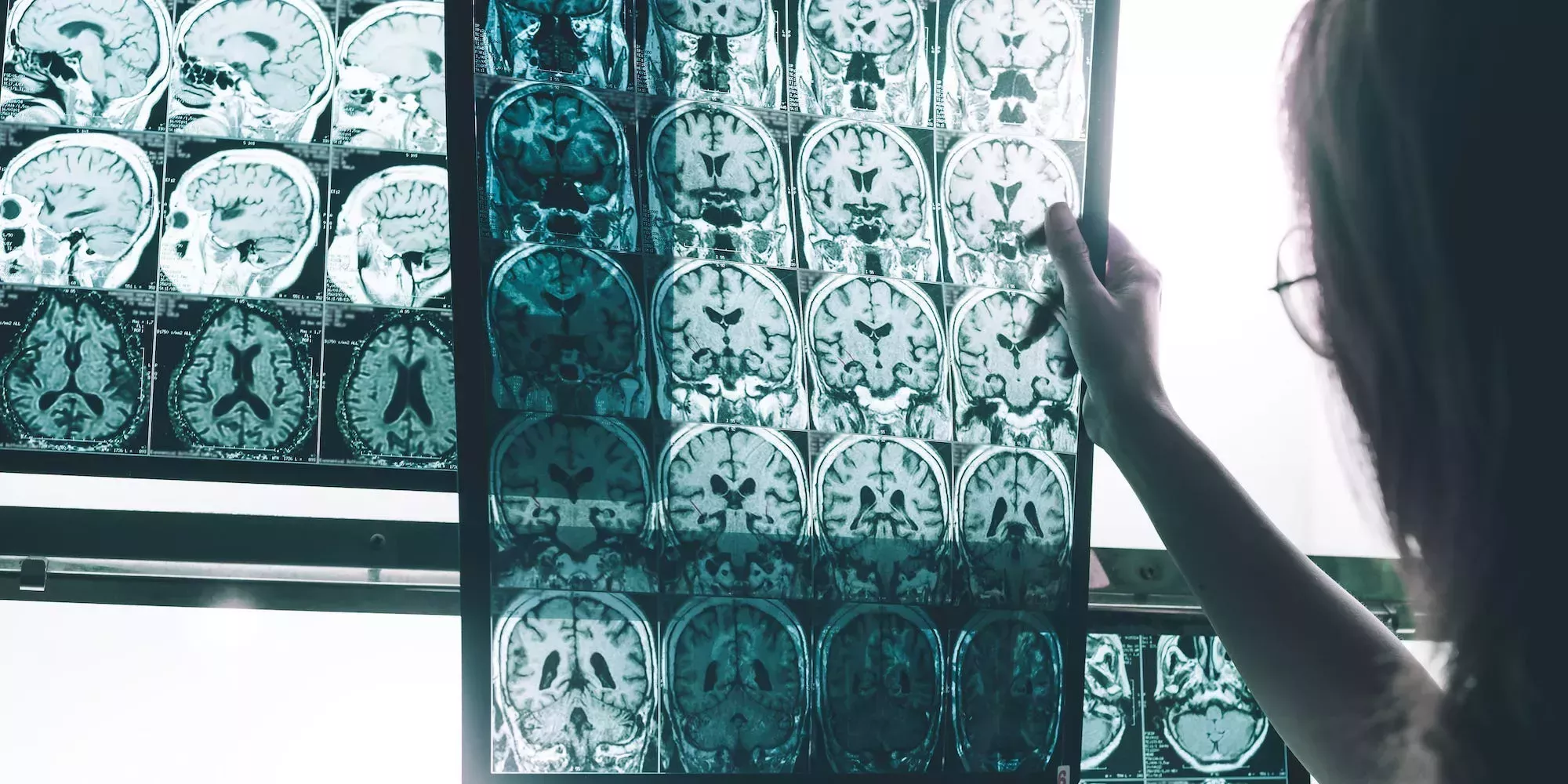 Un estudio revela que el racismo hace que los cerebros de los negros estadounidenses envejezcan más rápido que los de otras razas, lo que aumenta el riesgo de demencia