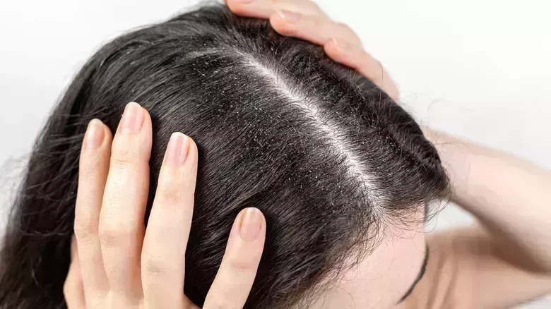 Problemas capilares que no debes ignorar si quieres una cabellera sana