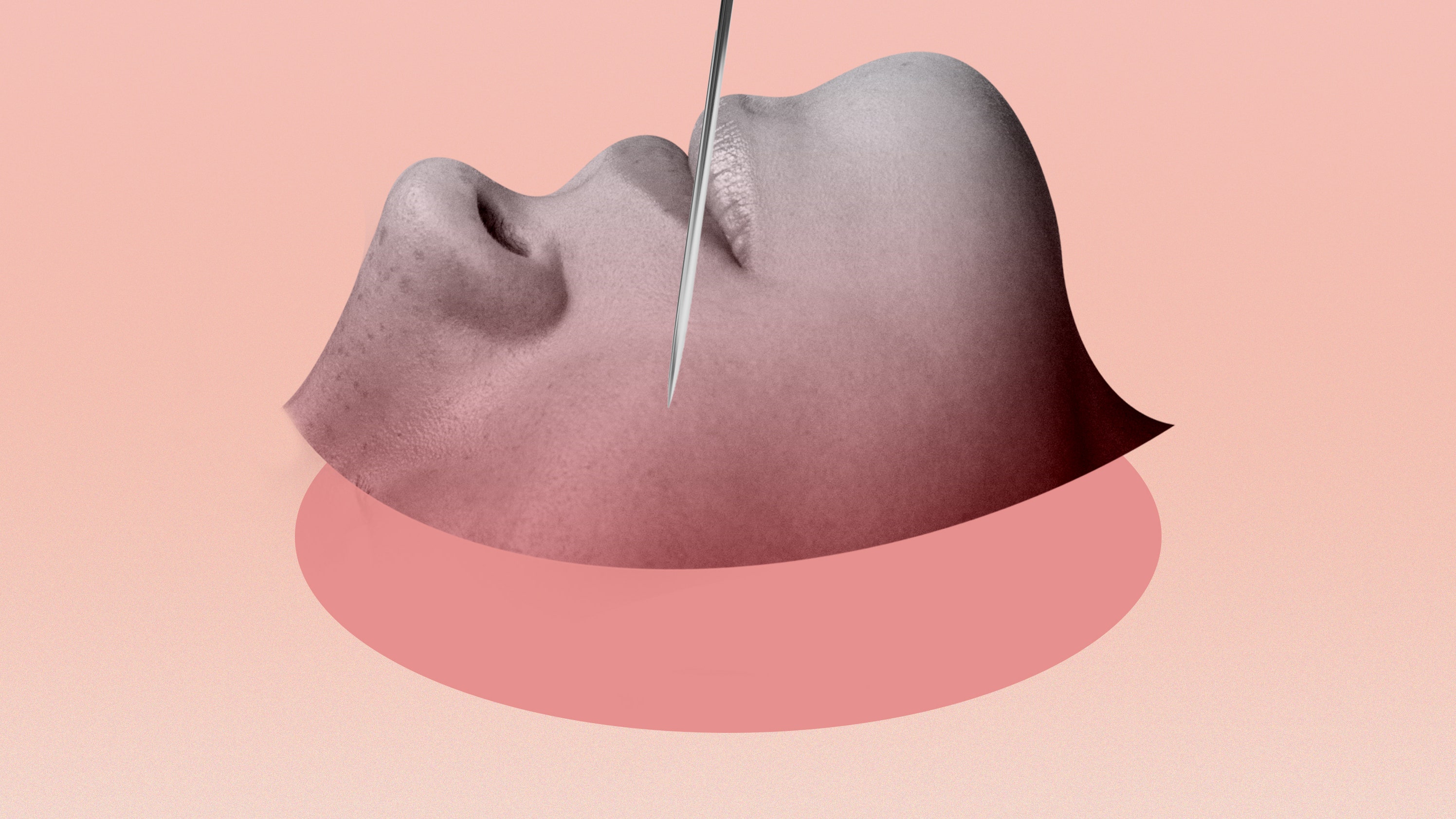 El microcorte es un tratamiento reafirmante que no requiere tiempo de inactividad