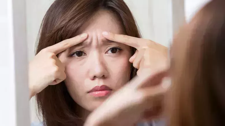 Mapa facial del acné: Por qué es importante saber qué tipo de brote tienes