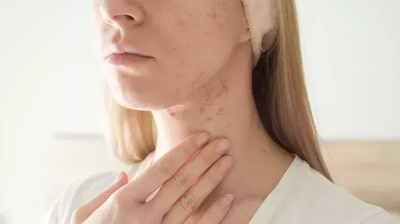 Diferentes tipos de brotes de acné (y las mejores formas de tratarlos)