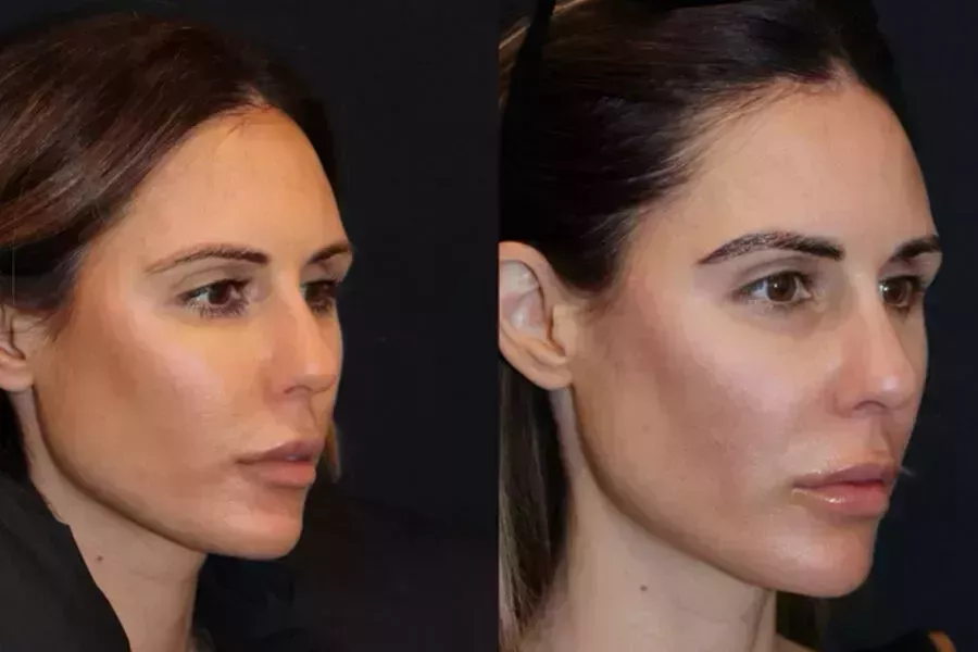 Sarah Howard&#8217;s Brow Transplant Journey-3