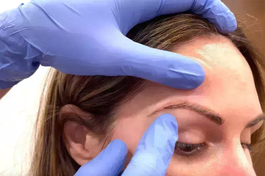 Sarah Howard&#8217;s Brow Transplant Journey-1