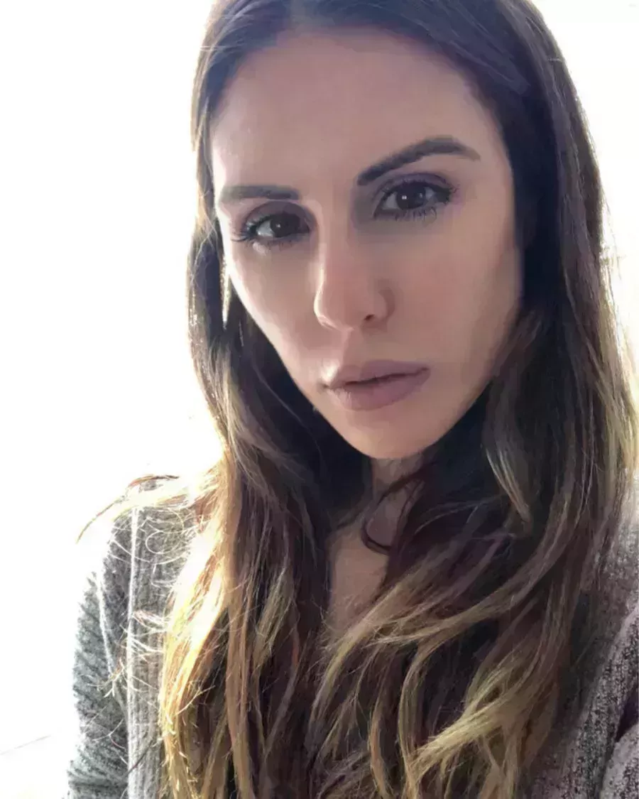 Sarah Howard&#8217;s Brow Transplant Journey-4