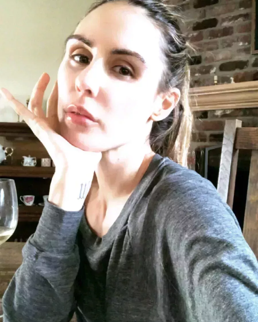 Sarah Howard&#8217;s Brow Transplant Journey-1