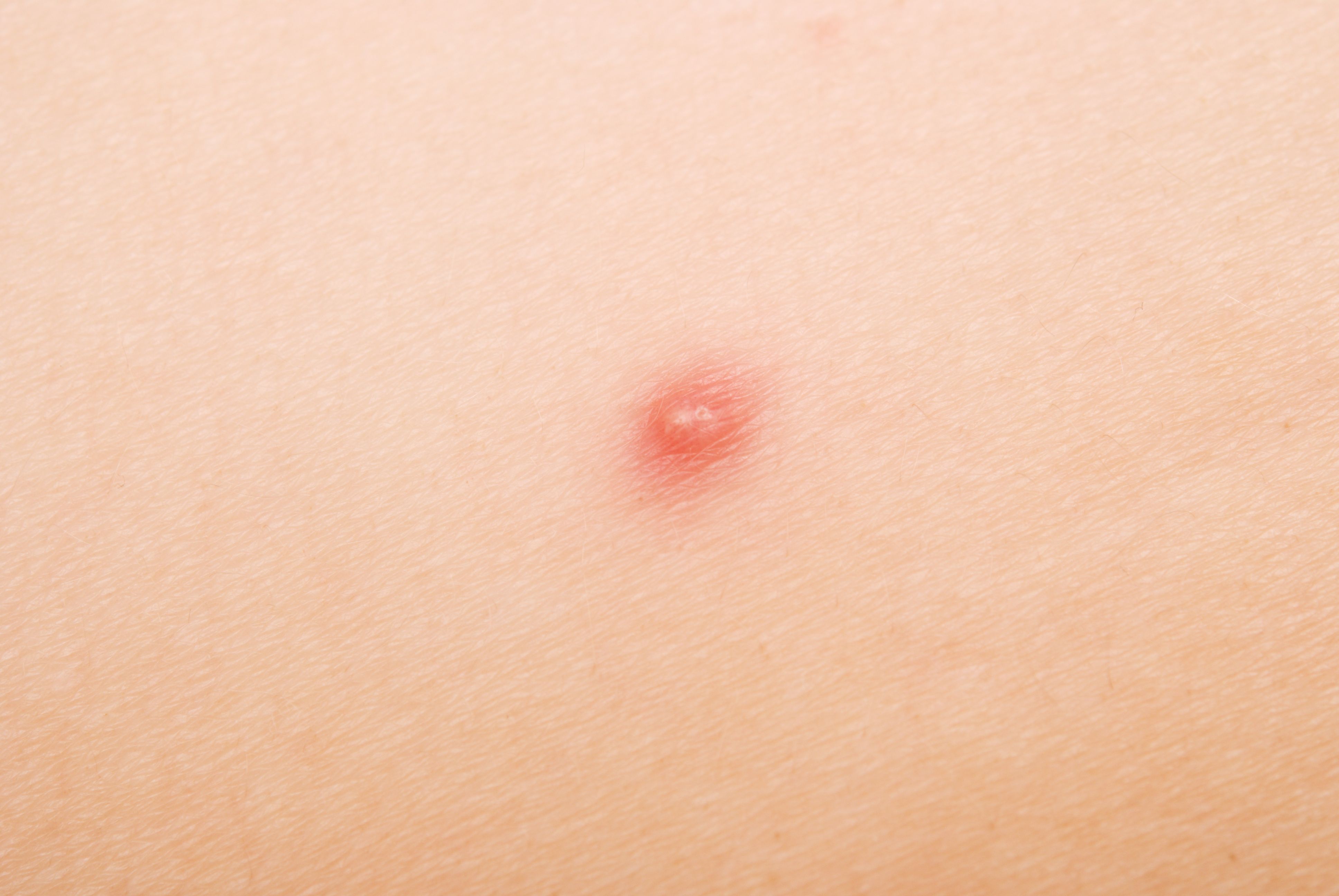 Debes saber cuál de estos seis tipos de acné tienes para tratarlo adecuadamente