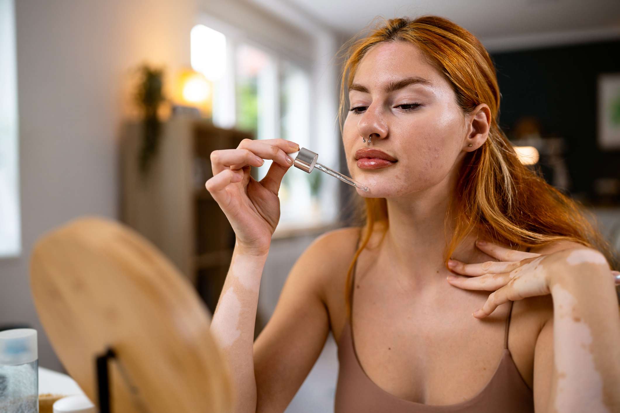 Cómo tratar el acné con peróxido de benzoilo