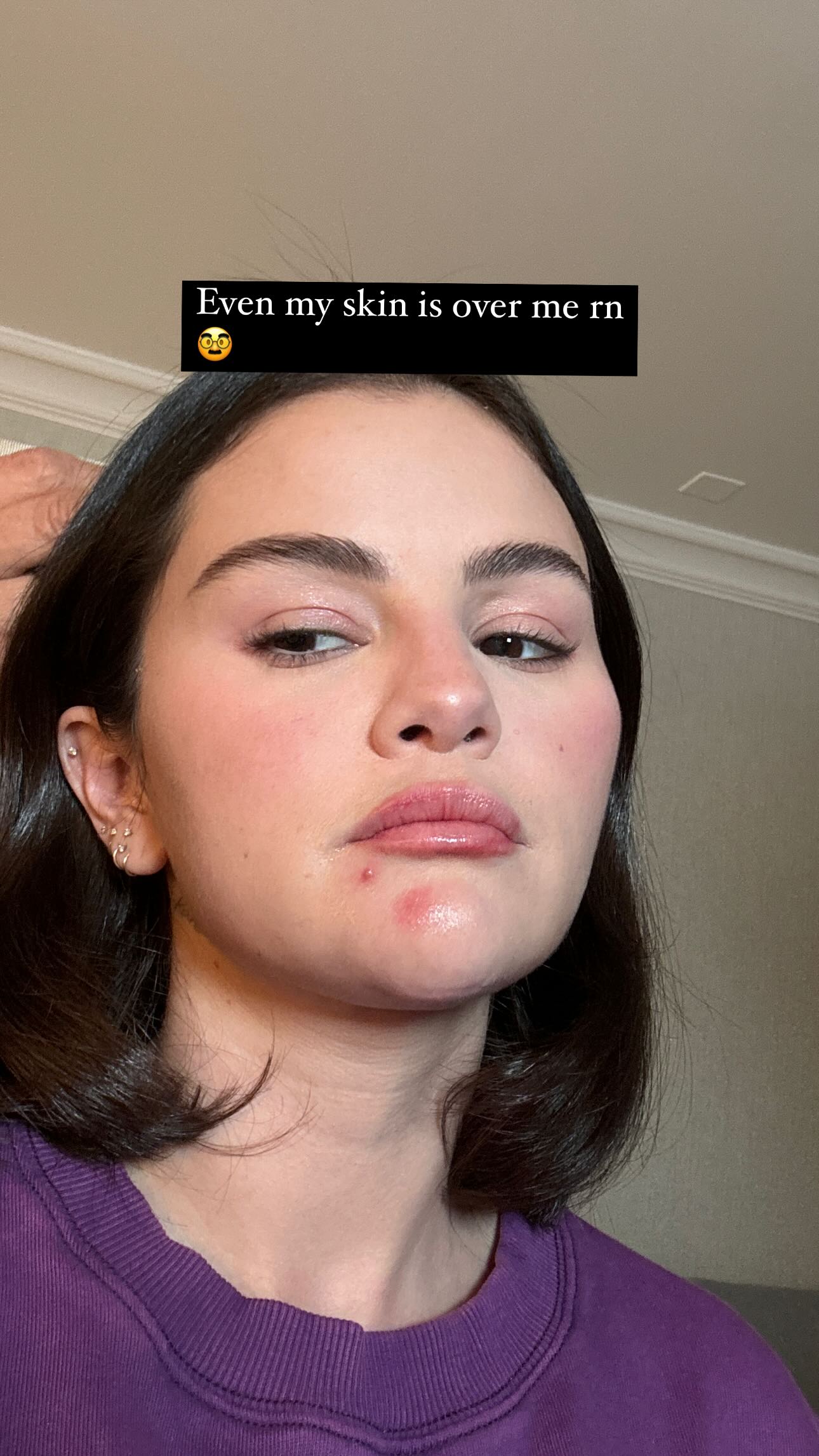 El Acné de Selena Gomez No Está "Superado" y Nos Encanta Su Autenticidad