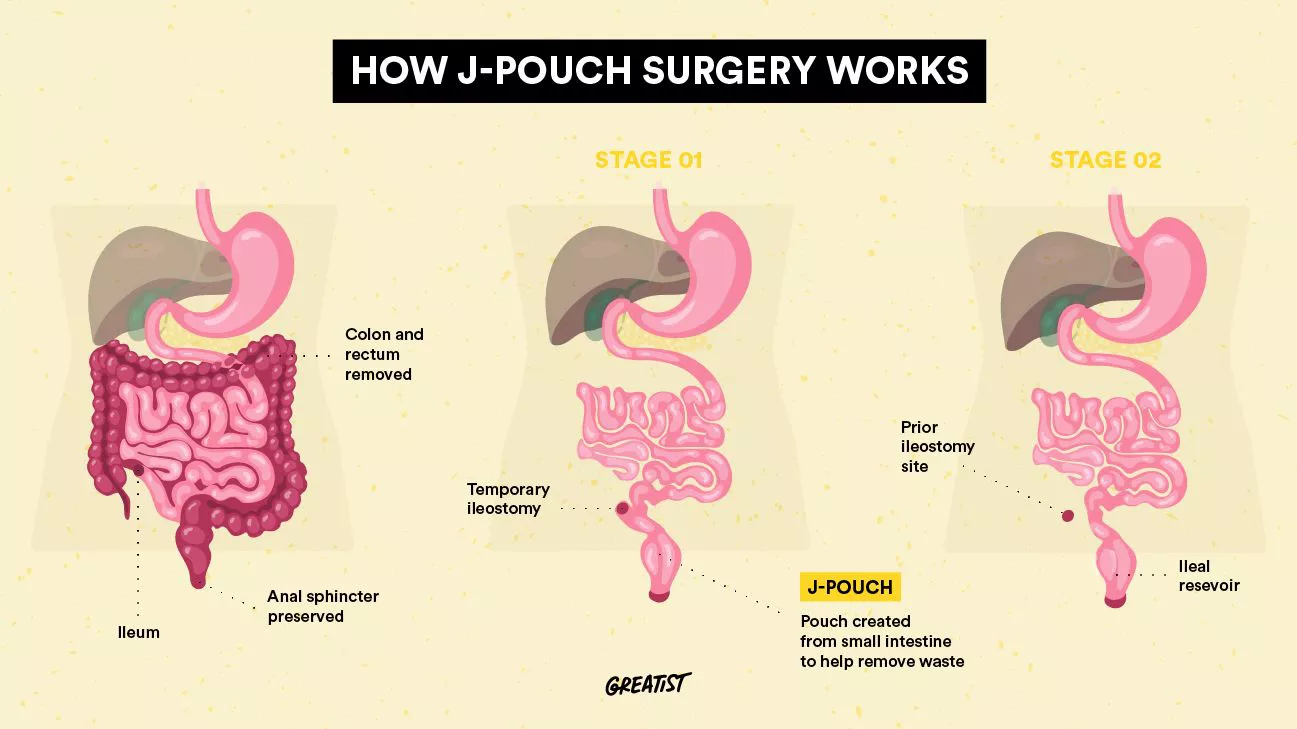 Entendiendo la Cirugía J-Pouch para el Alivio de la Colitis Ulcerosa