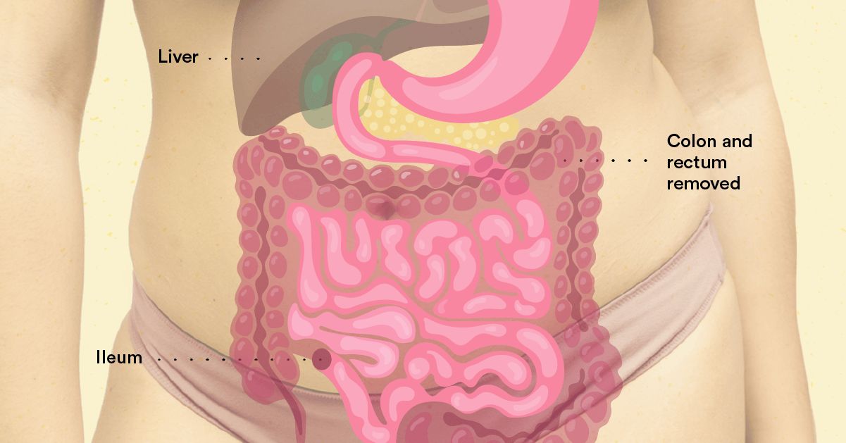 Entendiendo la Cirugía J-Pouch para el Alivio de la Colitis Ulcerosa
