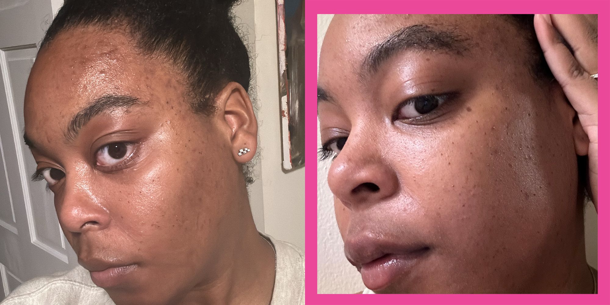 Este Suero Favorito de Dermatólogos Eliminó Mi Persistente Hiperpigmentación en Solo Cuatro Semanas