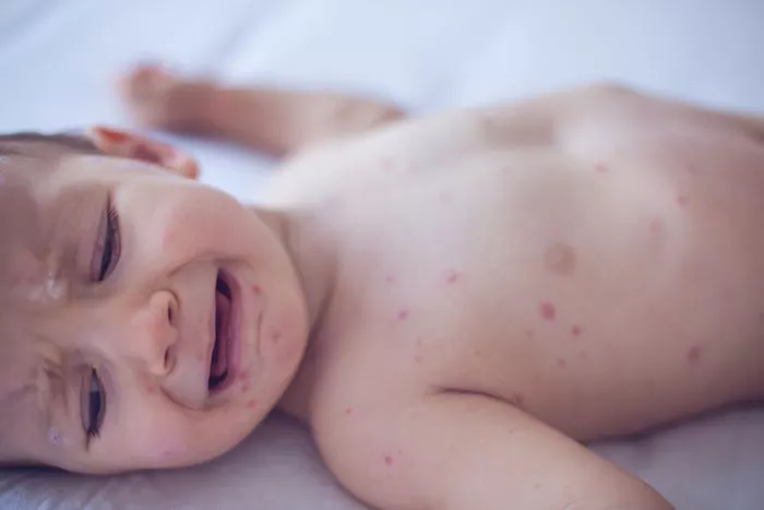 Crying baby girl with measles