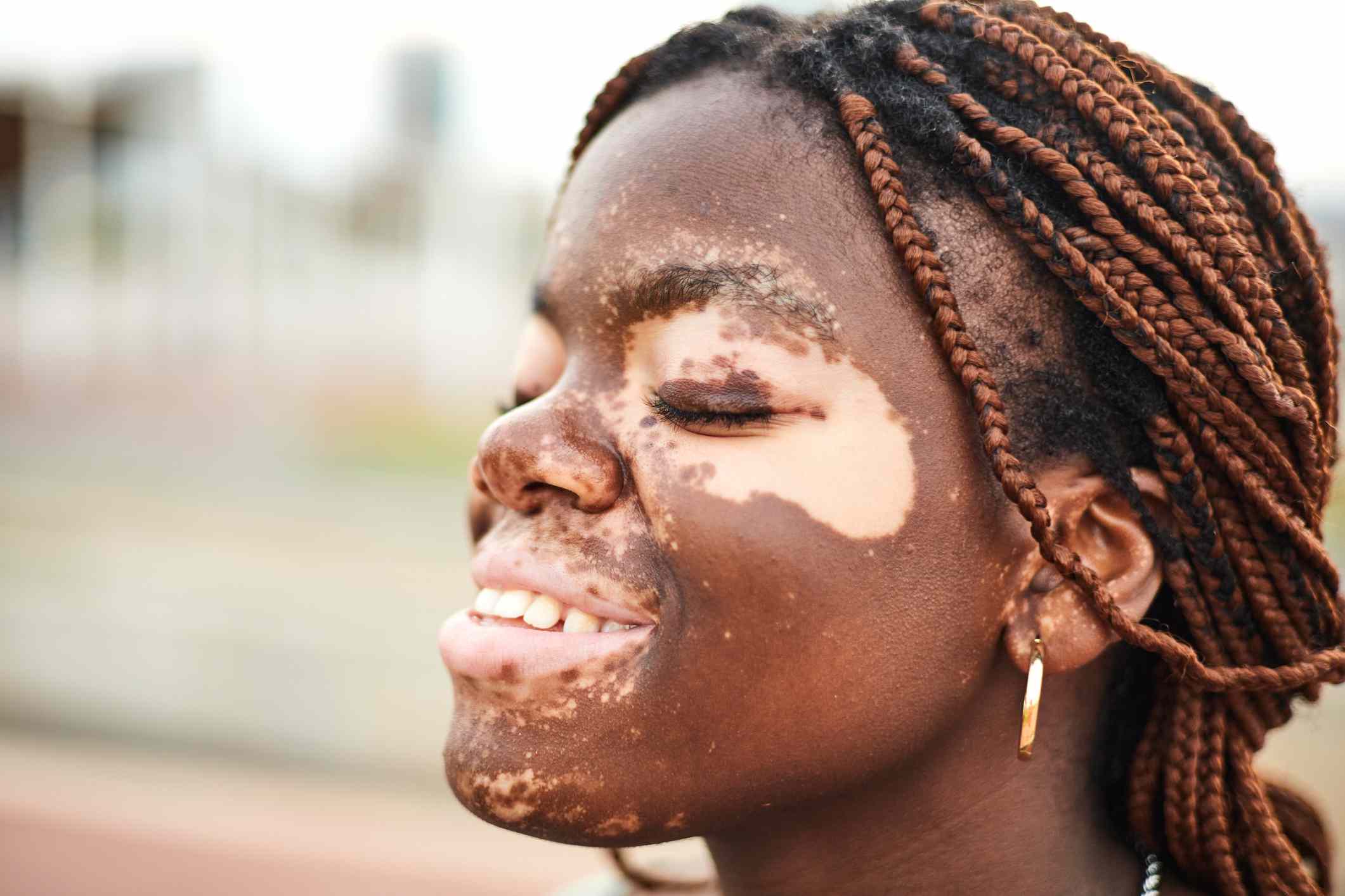 Qué causa la hipopigmentación (pérdida de pigmento en la piel)—y cómo se puede tratar