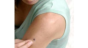 El cáncer de piel principal responsable de las muertes en mujeres jóvenes 