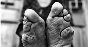 La tortura de los pies vendados en China