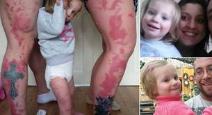 Se tatúan las manchas de nacimiento de su hija para que no se sienta diferente