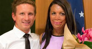 Esta modelo se quemó en un incendio y su novio le pidió matrimonio