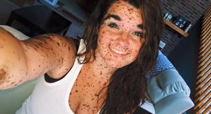 Joven con una extraña enfermedad en la piel se defiende de los que la insultan