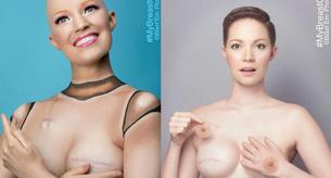 Esta mujer decidió mostrar su mastectomía con humor