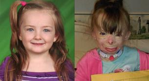 Esta niña se quemó en un incendio y todo lo que quiere por navidad son tarjetas