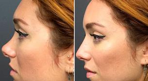 Así se modifica una nariz sin pasar por el quirófano