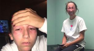 Esta chica se ha hecho viral 'gracias' a una hiedra venenosa 