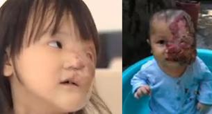 Recaudan fondos para darle un rostro nuevo a esta niña de 4 años