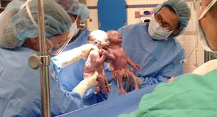 Compartieron bolsa amniótica y se dieron la mano nada más nacer