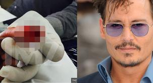 El dedo cortado de Johnny Depp tras una pelea con Amber Heard