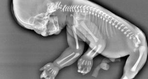 Decide abortar al descubrir que su hijo tiene las piernas unidas como una cola