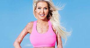 Hace 4 años la quemaron viva y ahora es todo un ejemplo de superación