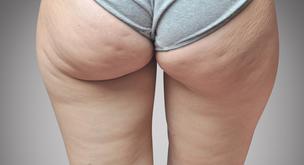 Estos son los mejores remedios caseros para la celulitis