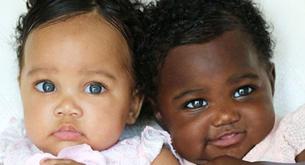 El asombroso caso de las gemelas con distinto color de piel