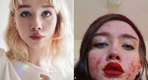 Esta Instagramer mostró su acné para romper con los estereotipos de belleza
