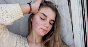 #acneisnormal: las mujeres se rebelan contra las pieles perfectas