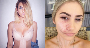 La modelo que fue ataca por un pit bull sufre burlas en internet